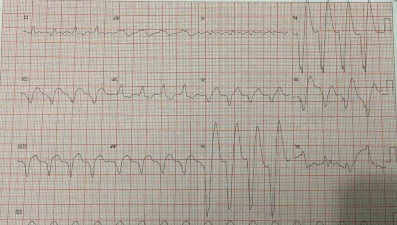 Eletrocardiograma