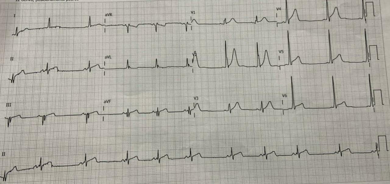 Eletrocardiograma