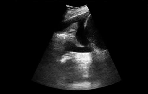 Ultrassom point-of-care